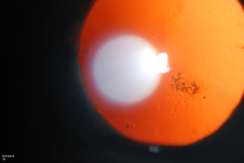 Polychromatic "Christmas Tree" Cataract
Patient comes in for annual eye exam. Eval on cataracts. VA is 20/20, right eye, 20/40, left eye. Slit Lamp exam shows polychromatic christmas tree cataract in the left eye.
