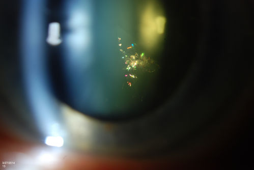 Polychromatic "Christmas Tree" Cataract
Patient comes in for annual eye exam. Eval on cataracts. VA is 20/20, right eye, 20/40, left eye. Slit Lamp exam shows polychromatic christmas tree cataract in the left eye.
