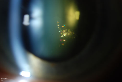 Polychromatic "Christmas Tree" Cataract
Patient comes in for annual eye exam. Eval on cataracts. VA is 20/20, right eye, 20/40, left eye. Slit Lamp exam shows polychromatic christmas tree cataract in the left eye.
