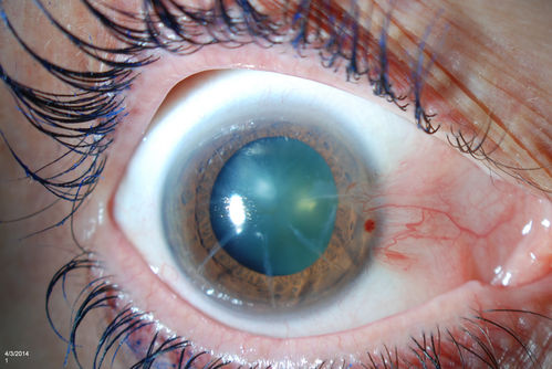 Pterygium and RK Scars
Patient comes in for SCL fitting. VA is 20/30. right eye and 20/70, left eye. Slit lamp photos show 8-RK Scars in both eyes. Pterygium, nasally, left eye. 
Keywords: april2014