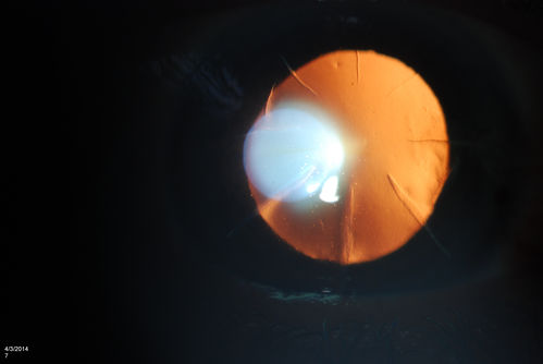 Pterygium and RK Scars
Patient comes in for SCL fitting. VA is 20/30. right eye and 20/70, left eye. Slit lamp photos show 8-RK Scars in both eyes. Pterygium, nasally, left eye. 
