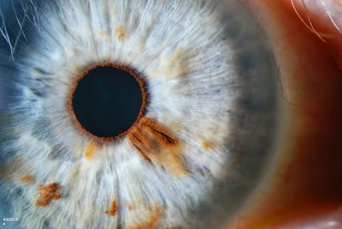 Iris Nevus
Routine eye exam. Iris nevus located around 4-o'clock off the pupil. 
