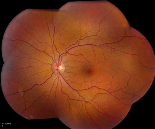 Pseudoxanthoma Elasticum with Angioid Streaks
Young female patient who comes in for routine eye exam, VA 20/20 in both eyes. Fundus photos shows a Peu'd orange appearance in the periphery of the retina and angioid streaks around the optic nerve. 
