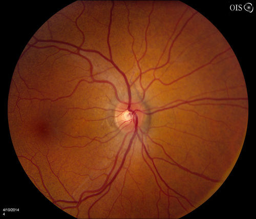 Pseudoxanthoma Elasticum with Angioid Streaks
Young female patient who comes in for routine eye exam, VA 20/20 in both eyes. Fundus photos shows a Peu'd orange appearance in the periphery of the retina and angioid streaks around the optic nerve. 
