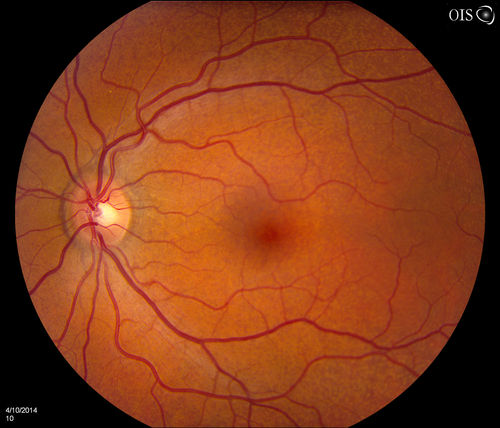 Pseudoxanthoma Elasticum with Angioid Streaks
Young female patient who comes in for routine eye exam, VA 20/20 in both eyes. Fundus photos shows a Peu'd orange appearance in the periphery of the retina and angioid streaks around the optic nerve. 
Keywords: april2014