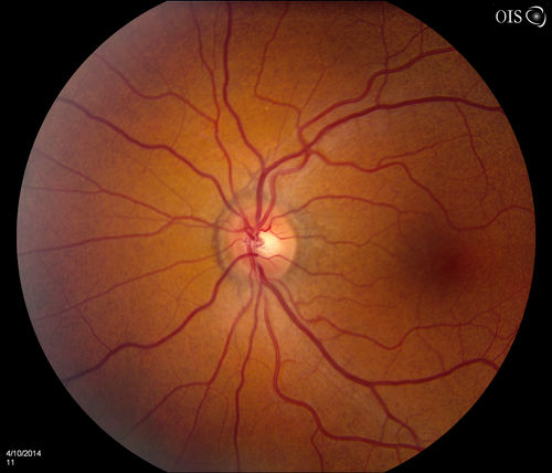 Pseudoxanthoma Elasticum with Angioid Streaks
Young female patient who comes in for routine eye exam, VA 20/20 in both eyes. Fundus photos shows a Peu'd orange appearance in the periphery of the retina and angioid streaks around the optic nerve. 
