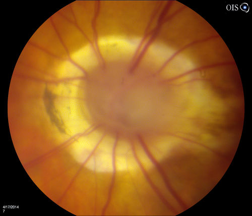 Morning Glory Syndrome, Optic Nerve
Patient comes in for cataract evaluation. VA 20/60, right eye and 20/150, left eye. Fundus photo shows "morning glory syndrome" of the optic nerve in the left eye. 

