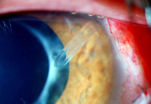 Ahmed Tube Placement
Patient with severe glaucoma is seen post op for ahmed tube placement. VA is 20/70 and IOP is 8 in the left eye. Patient is stable.
Keywords: May2014