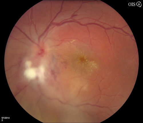 Macular Star, Toxoplasmosis
Young male with visual disturbance in the right eye. Fundus photo shows swelling around the optic nerve with macular star visible.

