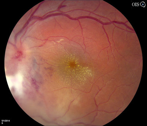 Macular Star, Toxoplasmosis
Young male with visual disturbance in the right eye. Fundus photo shows swelling around the optic nerve with macular star visible.
