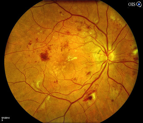 Diabetic Retinopathy with Scattered Hemorrhages. 
Diabetic patient with uncontrolled A1C comes in with blurred vision in the right eye. Fundus photo reveals scattered hemorrhages with cotton wool spots and some edema in the macula. Patient was treated with Avastin for edema.
