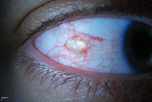 Conjunctival Cyst
Patient comes in with mechanical irritation in the right eye. No foreign body was found. Slit lamp photo shows conjunctival cyst was found temporal in the right eye. Patient will proceed with steroid/antibiotic drops and will stay out of contact lenses.
