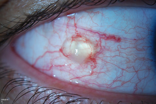 Conjunctival Cyst
Patient comes in with mechanical irritation in the right eye. No foreign body was found. Slit lamp photo shows conjunctival cyst was found temporal in the right eye. Patient will proceed with steroid/antibiotic drops and will stay out of contact lenses.
