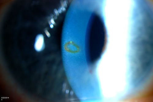 Foreign Body "Rust Ring" 
Patient complained of redness and tearing with white discharge. Patient was working with a grinding wheel on a vehicle. Slit lamp exam shows a rust ring barley off center. FBS was removed with Algiers Brush.
