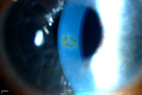 Foreign Body "Rust Ring" 
Patient complained of redness and tearing with white discharge. Patient was working with a grinding wheel on a vehicle. Slit lamp exam shows a rust ring barley off center. FBS was removed with Algiers Brush.
Keywords: May2014