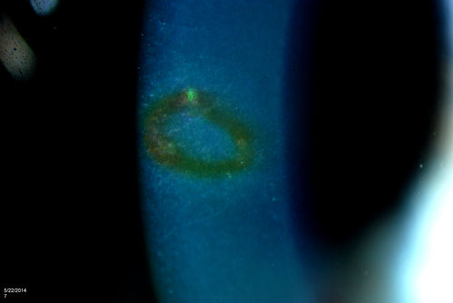 Foreign Body "Rust Ring" 
Patient complained of redness and tearing with white discharge. Patient was working with a grinding wheel on a vehicle. Slit lamp exam shows a rust ring barley off center. FBS was removed with Algiers Brush.
