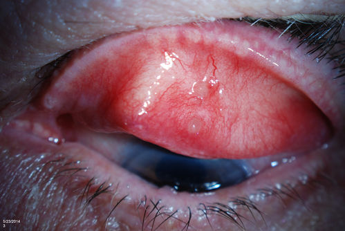 Pyogenic Granuloma, Elevated Concretion, LUL
Patient comes in with unresolved chalazia in the left upper eyelid. Slit lamp photo shows pyogenic granuloma. Performed in office procedure to remove them. 
