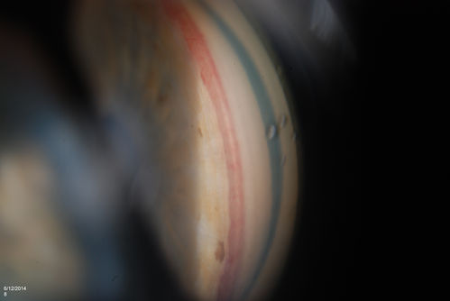 Gonioscopy, Neovascularization in the Angle
Neovascularization in the right eye, temporally. VA is 20/40, right eye with IOP at 25. Patient will proceed with Avastin injection to the right eye. 
