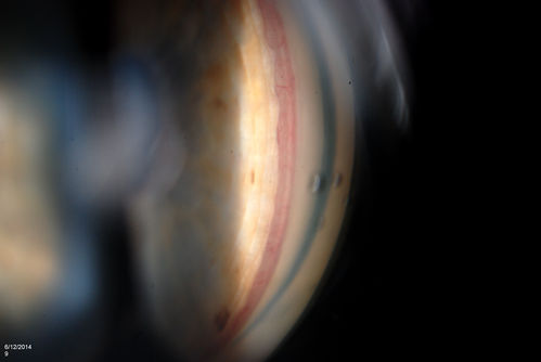 Gonioscopy, Neovascularization in the Angle
Neovascularization in the right eye, temporally. VA is 20/40, right eye with IOP at 25. Patient will proceed with Avastin injection to the right eye. 
Keywords: June2014