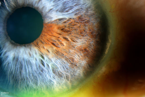 Dusted Pigment, Iris Nevus
Keywords: June2014