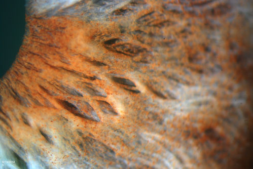 Dusted Pigment, Iris Nevus
