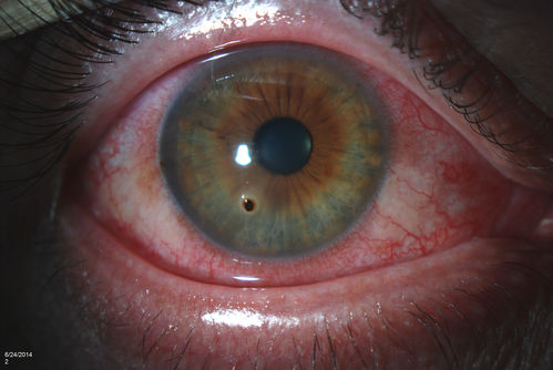 Corneal Foreign Body 
Patient complains of foreign body sensation in the right eye. Slit lamp photos shows a piece of glass metal embedded into the inferior part of the cornea at 7-o'clock in the right eye. Foreign body was removed. 
