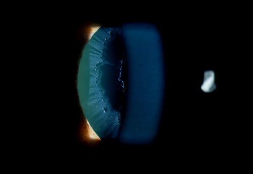 Severe Pseudoexfoliation Ring, Left Eye
Patient comes in for blurred vision. VA is 20/30 both eyes. Mostly at near which was corrected with refraction. Slit lamp photos show severe pseudoexfoliation in the left eye. Patient will be followed up for glaucoma eval in a few weeks. 
