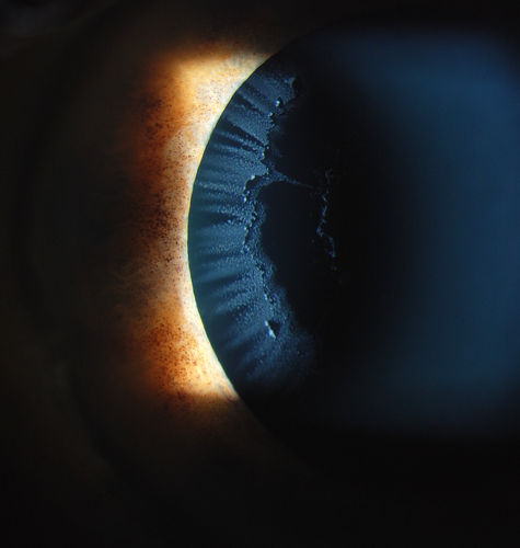 Severe Pseudoexfoliation Ring, Left Eye
Patient comes in for blurred vision. VA is 20/30 both eyes. Mostly at near which was corrected with refraction. Slit lamp photos show severe pseudoexfoliation in the left eye. Patient will be followed up for glaucoma eval in a few weeks. 
