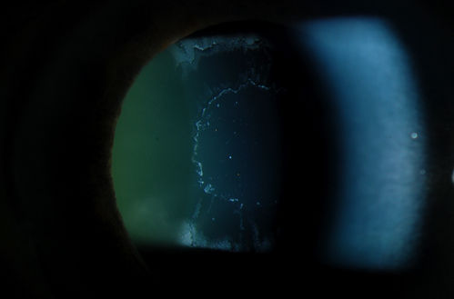 Severe Pseudoexfoliation Ring, Left Eye
Patient comes in for blurred vision. VA is 20/30 both eyes. Mostly at near which was corrected with refraction. Slit lamp photos show severe pseudoexfoliation in the left eye. Patient will be followed up for glaucoma eval in a few weeks. 
