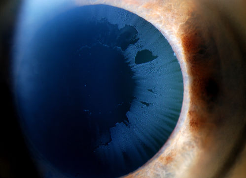 Severe Pseudoexfoliation Ring, Left Eye
Patient comes in for blurred vision. VA is 20/30 both eyes. Mostly at near which was corrected with refraction. Slit lamp photos show severe pseudoexfoliation in the left eye. Patient will be followed up for glaucoma eval in a few weeks. 
