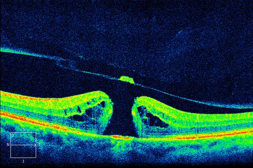 HD OCT of Macular Hole with Operculum

