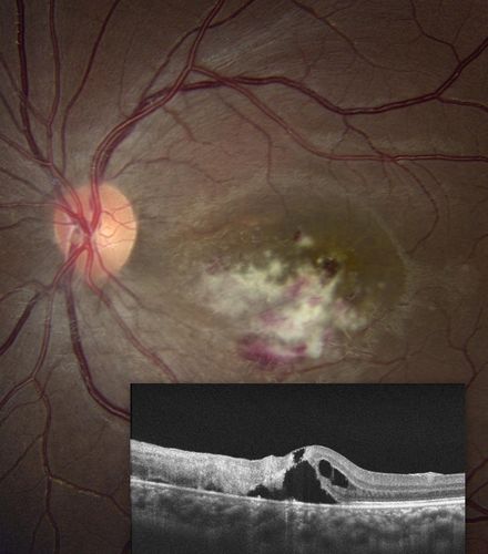 Cytomegalovirus Retinitis
Patient who is HIV Positive with Cytomegalovirus Retinitis. Patient was treated with Gangcyclovir Intra-Vitreal injection.
Keywords: april2013