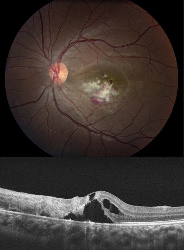 Cytomegalovirus Retinitis
Patient who is HIV Positive with Cytomegalovirus Retinitis. Patient was treated with Gangcyclovir Intra-Vitreal injection.
