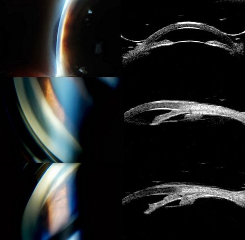 Angle Closure/ UBM & Gonioscopy
Patient comes in a day after dilation with severe headache and nausea. Patient's IOP was 64 in the right eye. Patient ended up having angle closure attack. Promoted severe nausea and eye pain. Peripheral Iridotomy was performed and IOP dropped slowly. Patient was followed up the next morning and will be seen 2-days after that. 
Keywords: june2013