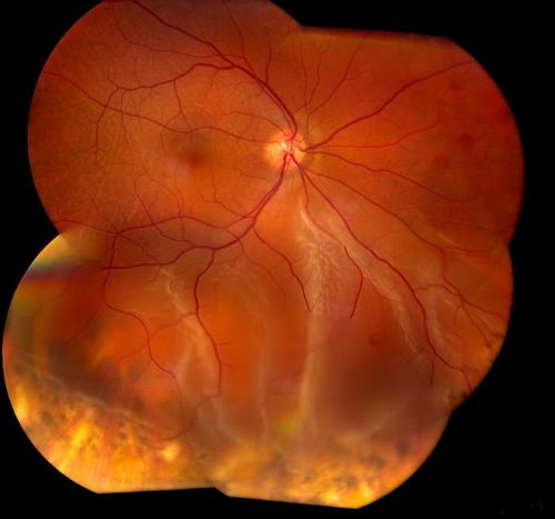 Retinal Detachment
Keywords: Retinal Detachment