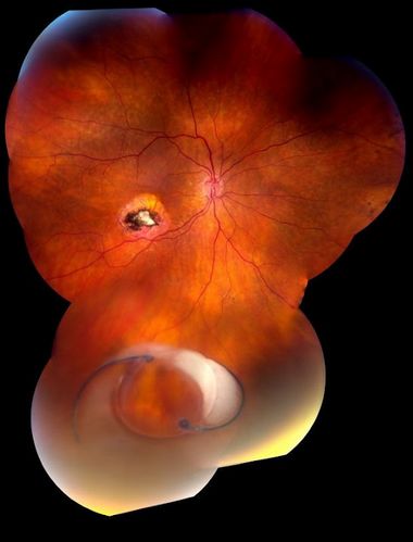 Dislocated Intraocular Lens
Dislocated Intraocular Lens 
