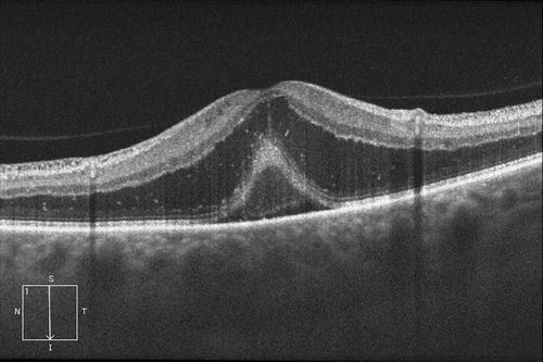 Optic Neuritis/Neuroretinitis
Pt. states lost some vision in his left eye last week, was seen by eye MD and referred for eval.  Also complains of pain in left eye with eye movement. VA was 20/400 in the left eye. Fundus photo and HD-OCT imaging show optic nerve swelling and fluid underneath the retina. Will consult with Neuro-Ophthalmologist for further evaluation.

