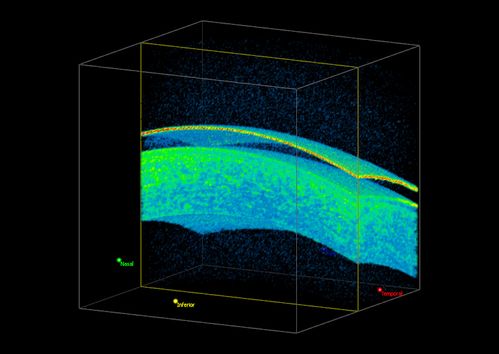 3-D HD OCT Image of Soft Contact Lens over Cornea
