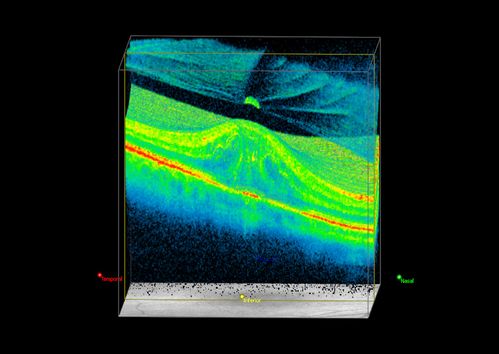 3-D OCT of Macular Hole with Operculum
