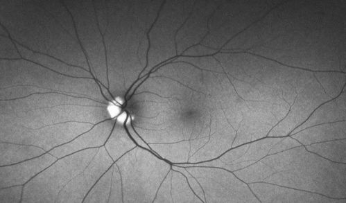Bilateral Optic Nerve Drusen
