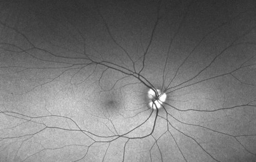 Bilateral Optic Nerve Drusen
