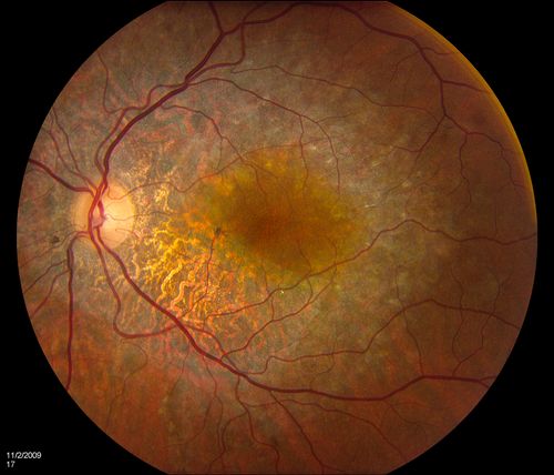 Alphamethlyacyl COA Racemase Deficiency
