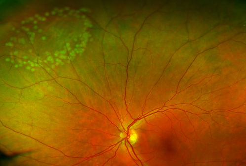 Retinal Tear with Laser Treatment
Patient comes in with blurry vision and mild floaters in the left eye. Fundus photo shows retinal tear with fluid present in the superior nasal quadrant of the left eye. Laser Retinopexy was performed to fix the retinal tear. 
Keywords: september2014