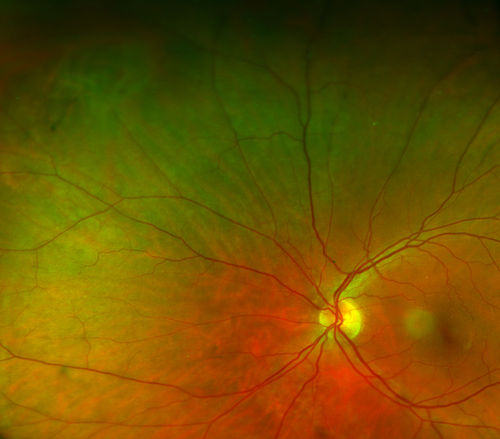 Retinal Tear with Laser Treatment
Patient comes in with blurry vision and mild floaters in the left eye. Fundus photo shows retinal tear with fluid present in the superior nasal quadrant of the left eye. Laser Retinopexy was performed to fix the retinal tear. 
