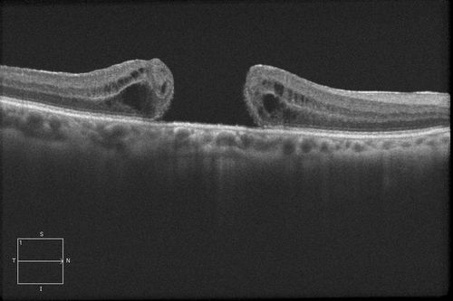 Keywords: macular hole