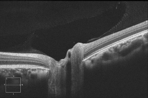 HD Grayscale OCT of Optic Nerve with Vitreous pulling 
