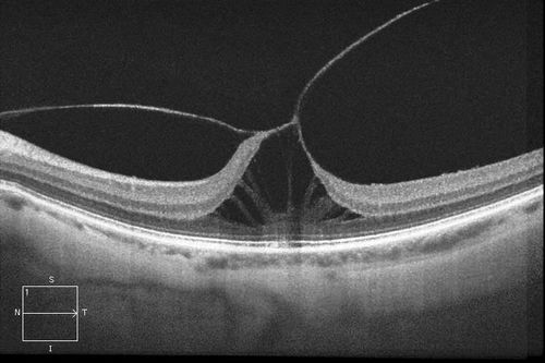 Symptomatic Vitreomacular Traction 
Patient comes in with loss of light reflection to the left eye. HD-OCT shows Symptomatic Vitreomacular Traction to the left eye. Patient was injected with Jetrea and will be seen back in 2-weeks for follow-up. 
