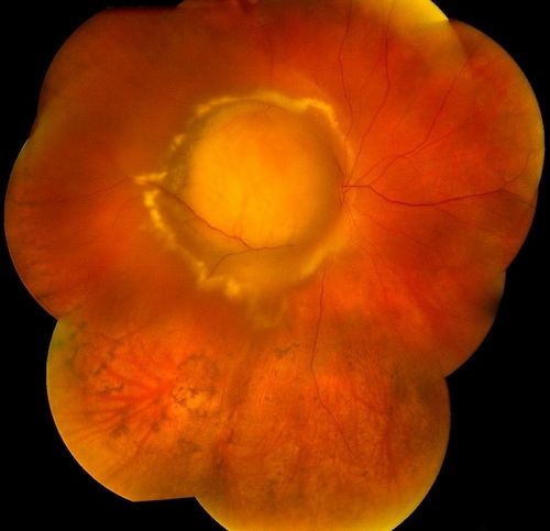 Choroidal Melanoma
