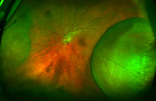 Non-Kissing Choroidals 
Fluid and blood underneath the choroid nasally and temporally after cataract surgery in the left eye
