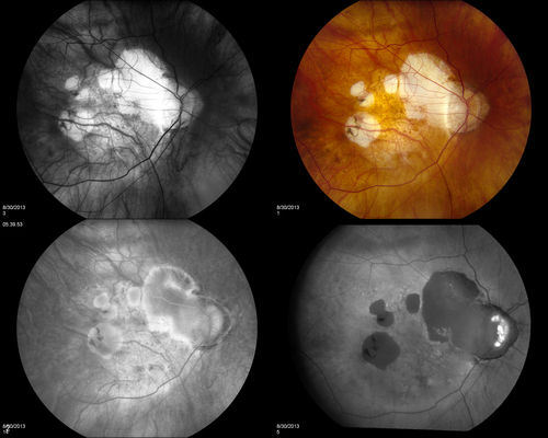 Myopic Maculoscheisis
Fluorescence Angiography and Fundus photography shows RPE mottling and staphyloma in the right eye. VA is 20/50, right eye. No sub retinal fluid found. 
